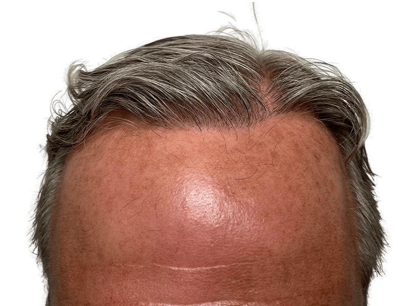 Hair transplant result: Improved hairline density on fair skin. Before & after hair restoration procedure.