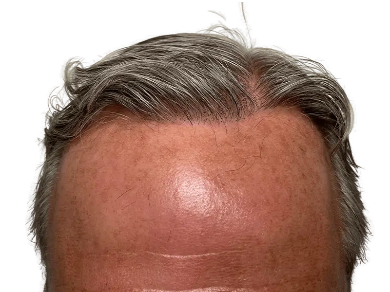 Hair transplant result: Improved hairline density on fair skin. Before & after hair restoration procedure.
