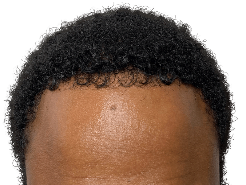 Hair restoration candidate. Close-up of hairline. Consider hair transplant before/after for density and position changes.