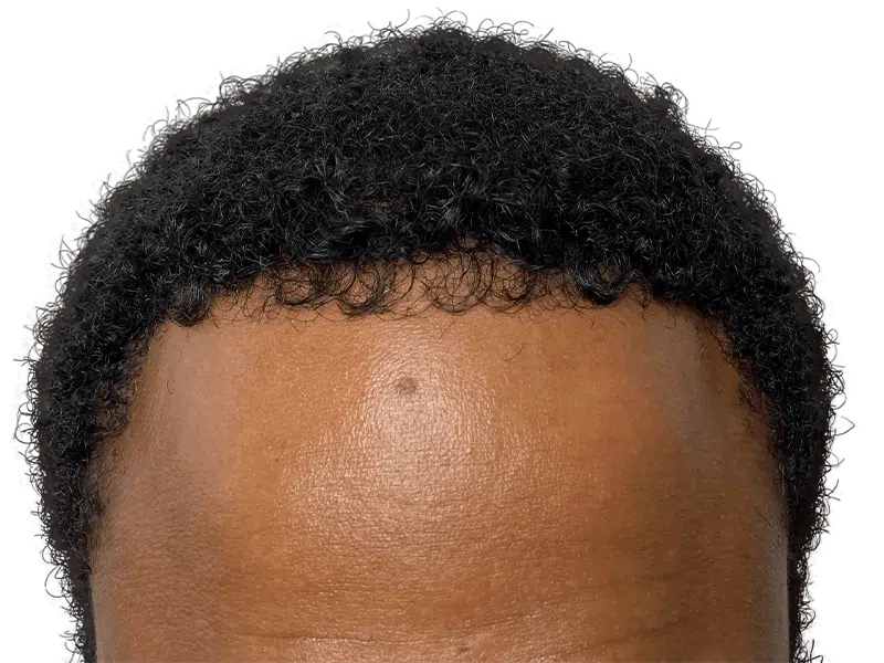 Hair restoration candidate. Close-up of hairline. Consider hair transplant before/after for density and position changes.