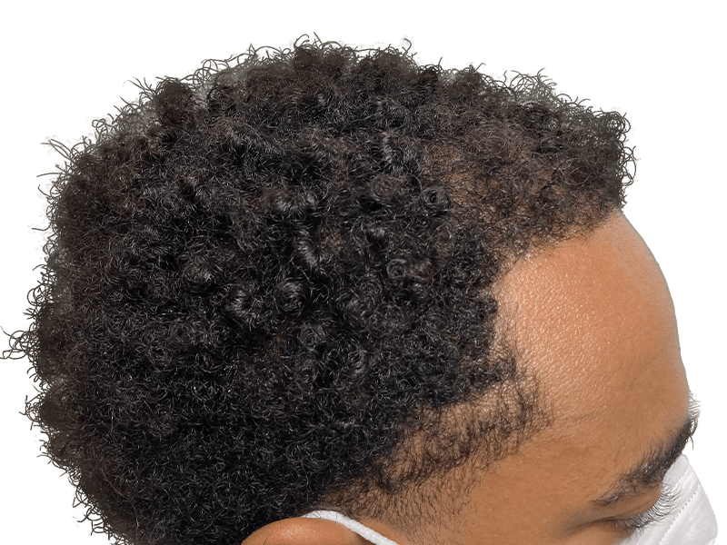 Hair transplant before & after: Fuller hairline achieved. African American/Hispanic patient. Hair restoration results.