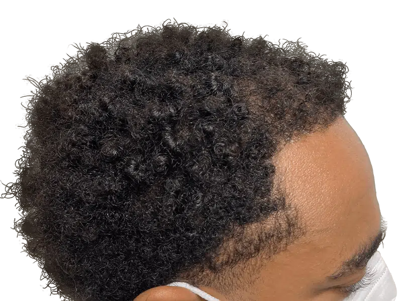 Hair transplant before & after: Fuller hairline achieved. African American/Hispanic patient. Hair restoration results.