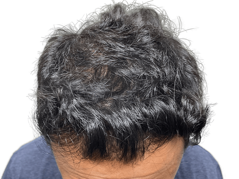 Thinning dark hair. Potential hair transplant candidate. Consider hair restoration options for fuller hair.