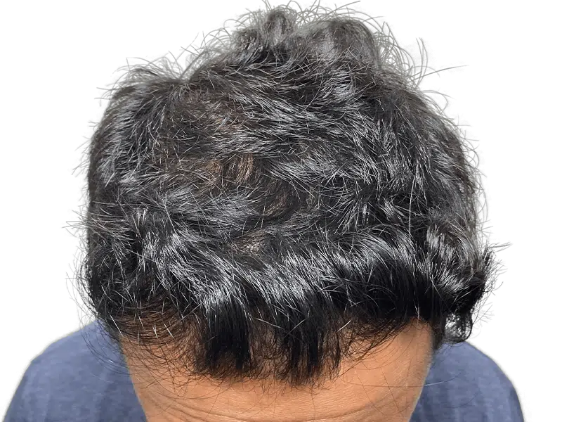 Thinning dark hair. Potential hair transplant candidate. Consider hair restoration options for fuller hair.