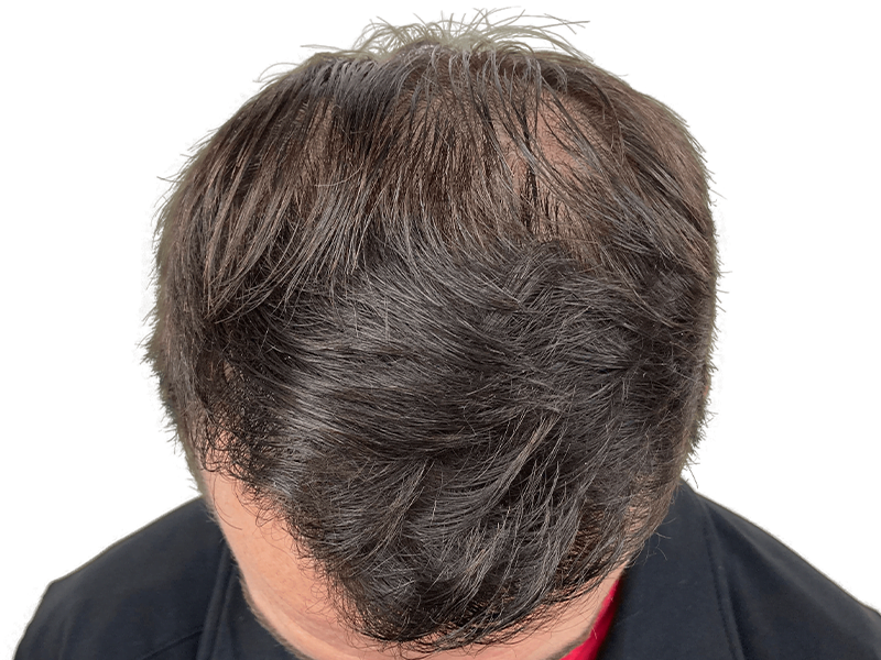 Thinning dark brown hair at the crown. Potential hair restoration candidate. Natural hair, pre-transplant assessment.