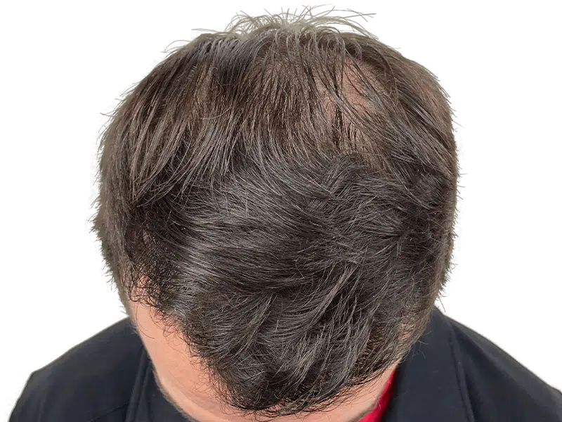 Thinning dark brown hair at the crown. Potential hair restoration candidate. Natural hair, pre-transplant assessment.