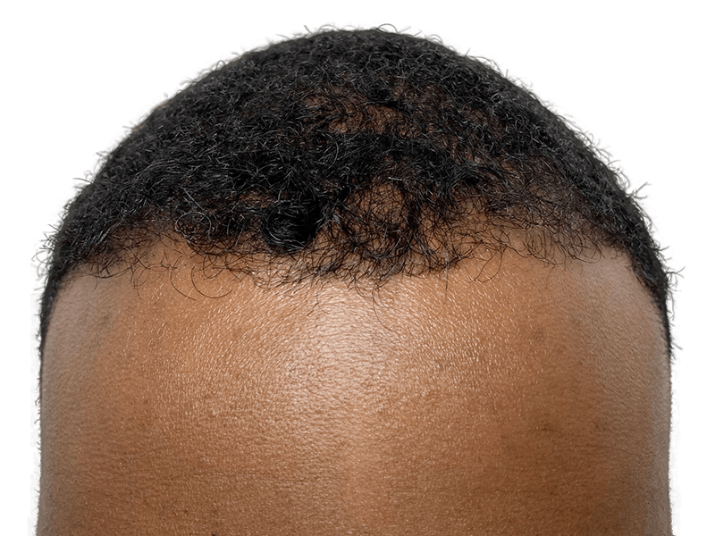Hair transplant result: African American man's hairline restored. Dark, curly hair growth. Hair restoration success.