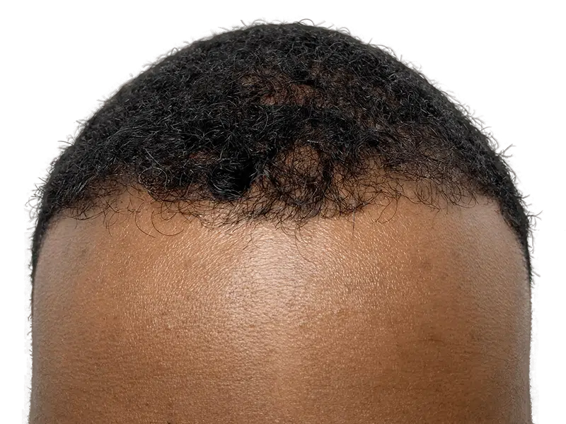 Hair transplant result: African American man's hairline restored. Dark, curly hair growth. Hair restoration success.