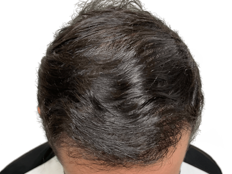 Natural, dark, wavy hair. Could be a 'before' photo for hair restoration or transplant results. Healthy hair growth.
