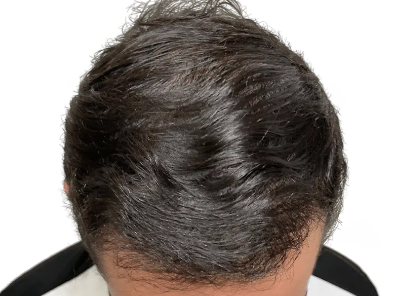 Natural, dark, wavy hair. Could be a 'before' photo for hair restoration or transplant results. Healthy hair growth.