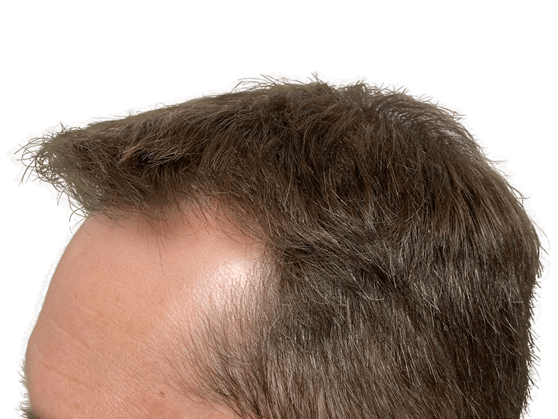 Before hair transplant: Receding hairline, thinning brown hair. Hair restoration results possible.
