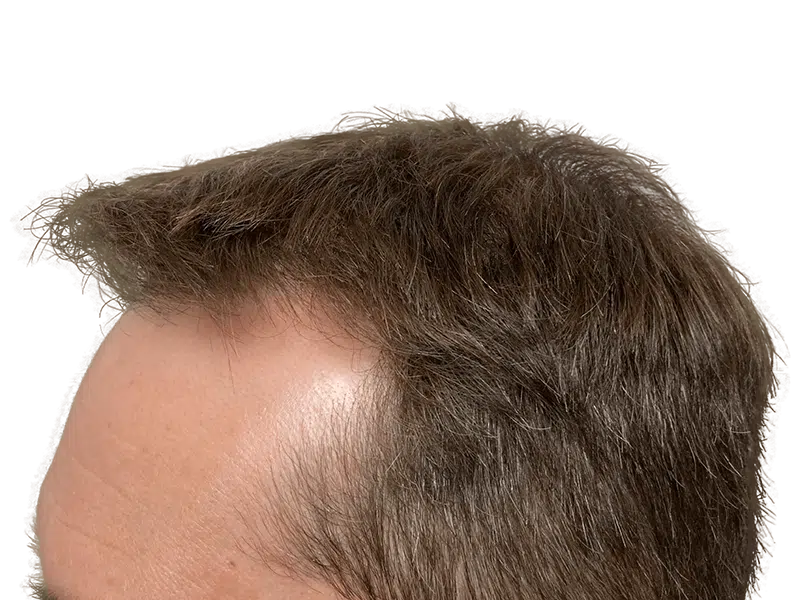 Before hair transplant: Receding hairline, thinning brown hair. Hair restoration results possible.