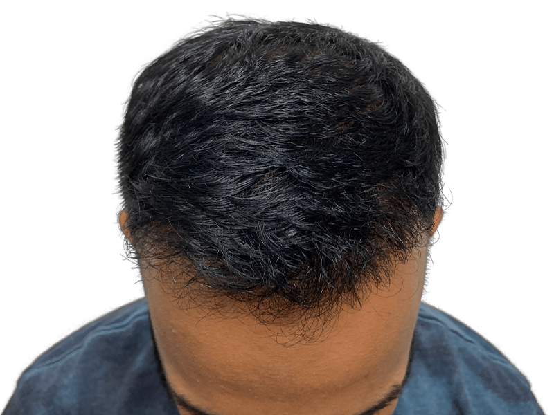 Hair thinning at hairline. Potential hair transplant candidate. Dark, wavy hair. Consider hair restoration options.