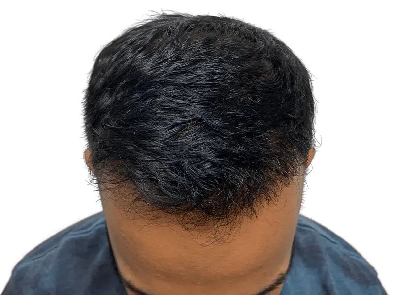 Hair thinning at hairline. Potential hair transplant candidate. Dark, wavy hair. Consider hair restoration options.
