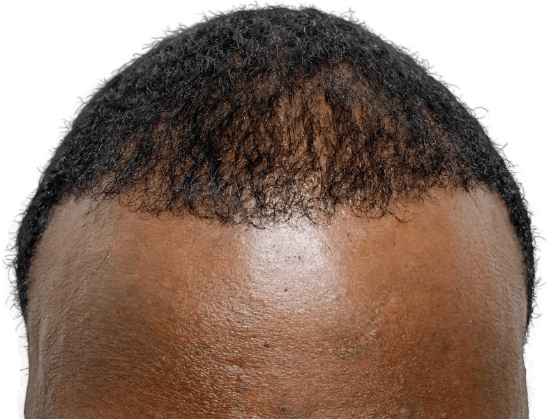 Receding hairline before hair transplant. Dark, curly hair with visible scalp. Hair restoration candidate. Before photo.