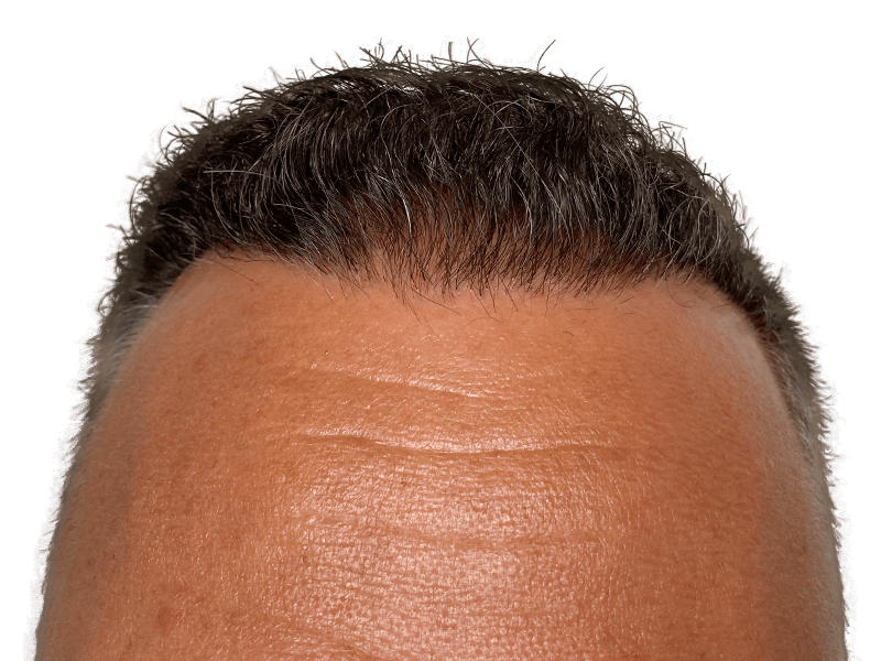 Hair transplant result: Graying man's restored hairline. See the difference! Hair restoration success.