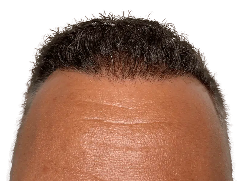 Hair transplant result: Graying man's restored hairline. See the difference! Hair restoration success.