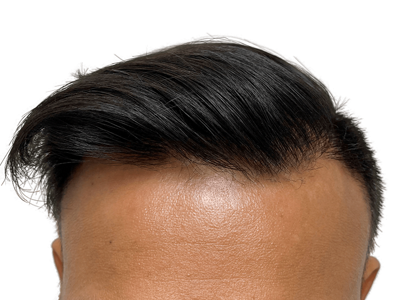 Hair transplant result: Natural, dense hairline on Asian man. Before & after hair restoration success.
