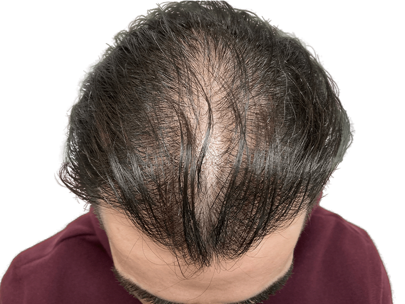 Thinning dark hair at crown & hairline. Potential hair loss. Before hair restoration treatment. Caucasian male.