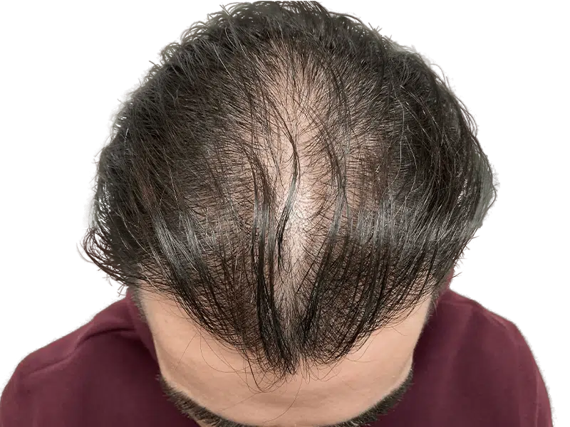 Thinning dark hair at crown & hairline. Potential hair loss. Before hair restoration treatment. Caucasian male.