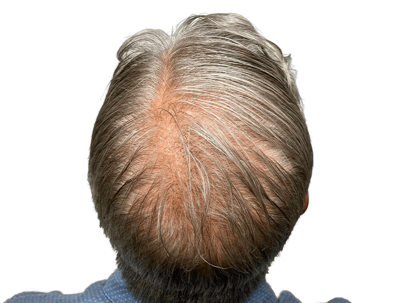 Thinning gray hair on crown. Hair loss example. Consider hair restoration or transplant options for fuller hair.
