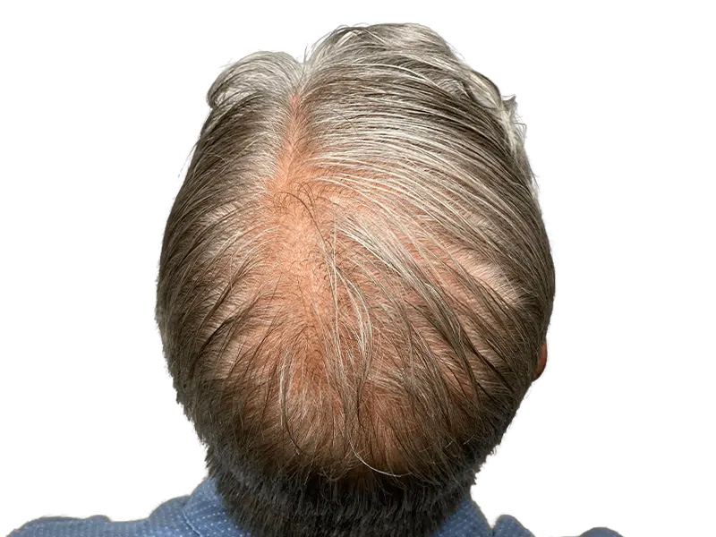 Thinning gray hair on crown. Hair loss example. Consider hair restoration or transplant options for fuller hair.