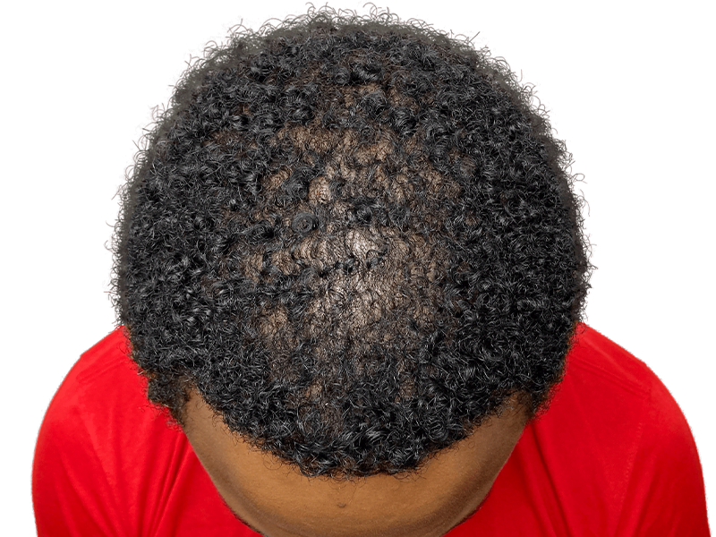 Hair thinning in Black man before hair transplant. Crown balding, red shirt, brown background. Hair restoration results possible.