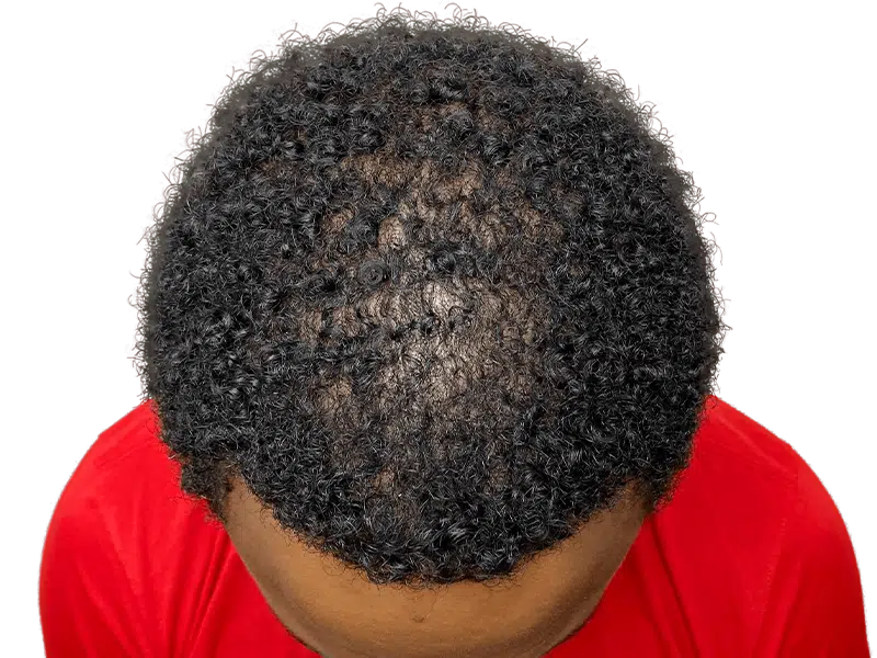 Hair thinning in Black man before hair transplant. Crown balding, red shirt, brown background. Hair restoration results possible.