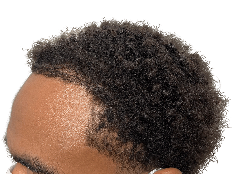 Hair restoration candidate. Close-up of Afro-textured hair. Consider hair transplant options for fuller hair.