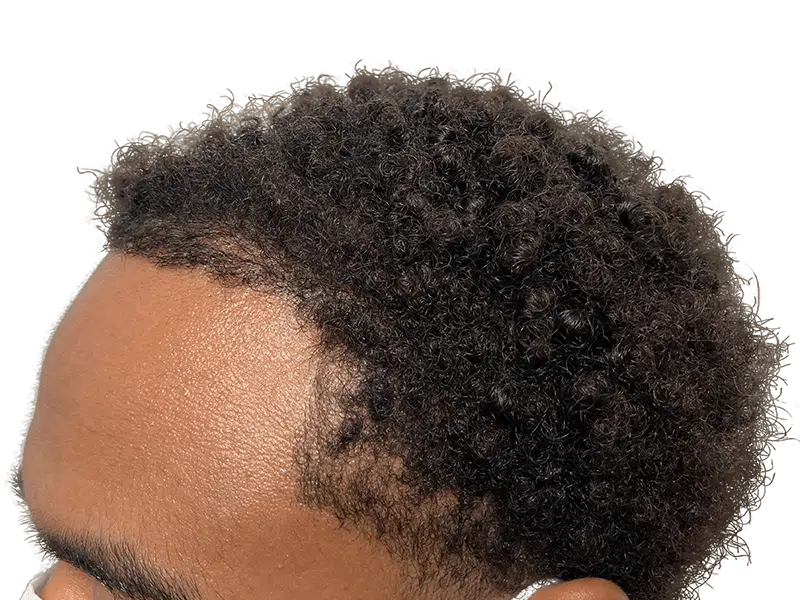 Hair restoration candidate. Close-up of Afro-textured hair. Consider hair transplant options for fuller hair.