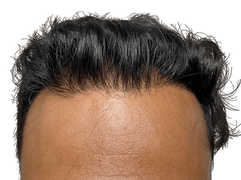 Hair transplant result: Restored hairline on Asian man. Dense, natural-looking hair. Before & after transformation.