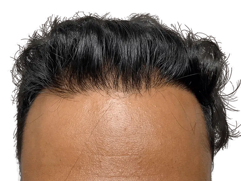 Hair transplant result: Restored hairline on Asian man. Dense, natural-looking hair. Before & after transformation.