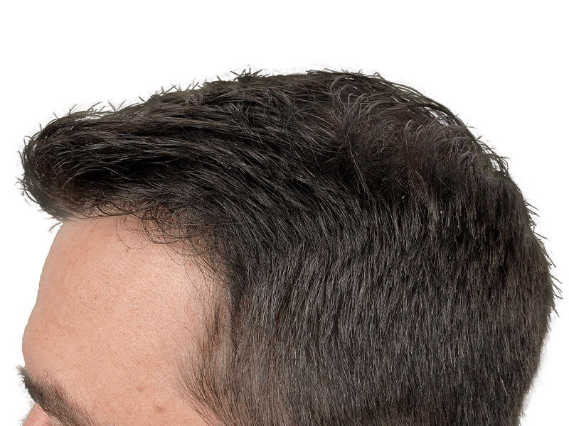 Hair transplant result: Fuller, natural hairline restoration. Before & after potential. Caucasian male.