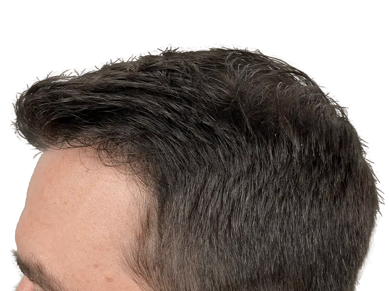 Hair transplant result: Fuller, natural hairline restoration. Before & after potential. Caucasian male.