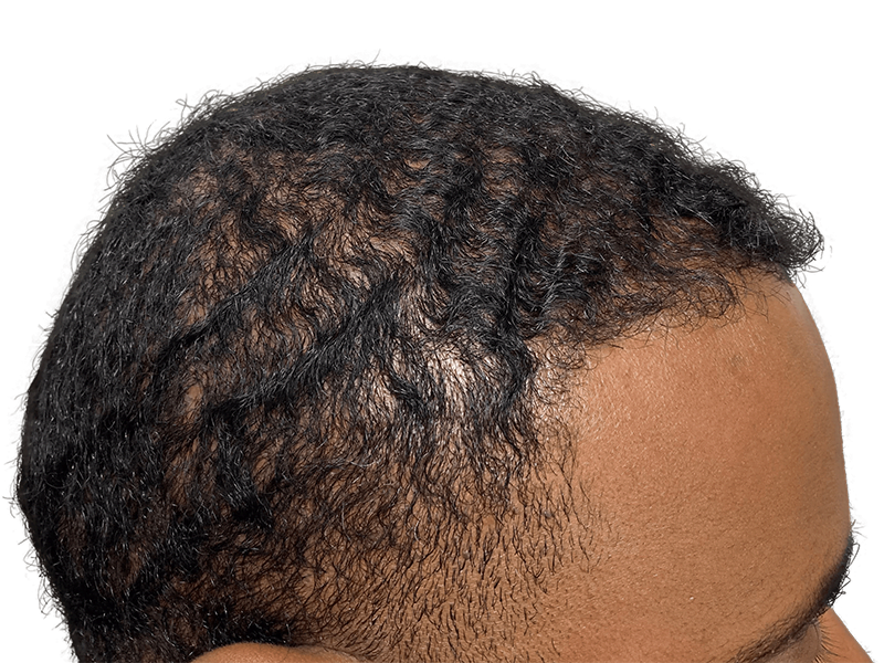 Thinning hairline on dark, curly hair. Hair loss example for hair restoration or transplant consideration.