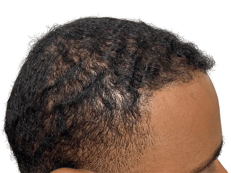 Thinning hairline on dark, curly hair. Hair loss example for hair restoration or transplant consideration.