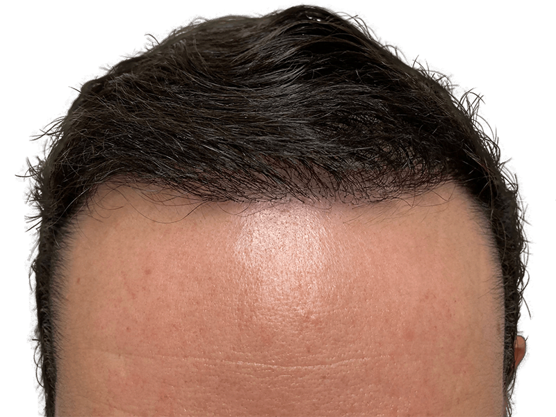 Hair transplant result: Dense, natural hairline restoration. Dark hair, smooth forehead. Potential before/after example.