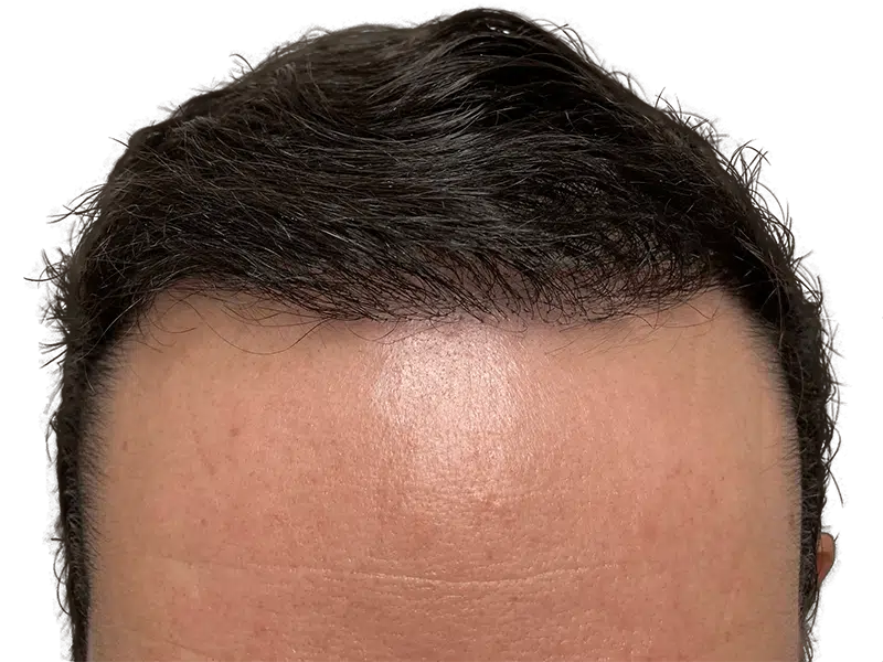 Hair transplant result: Dense, natural hairline restoration. Dark hair, smooth forehead. Potential before/after example.