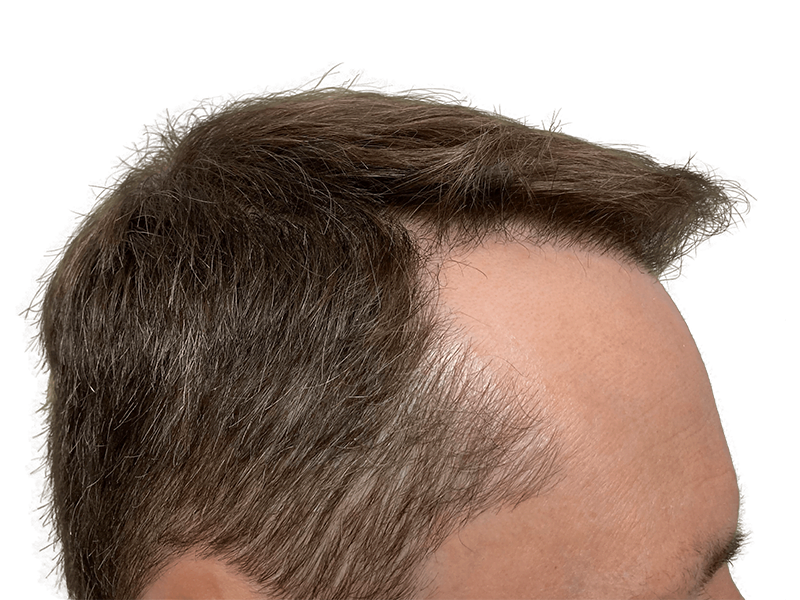 Receding hairline. Before hair transplant. Brown hair with gray. Hair restoration candidate.