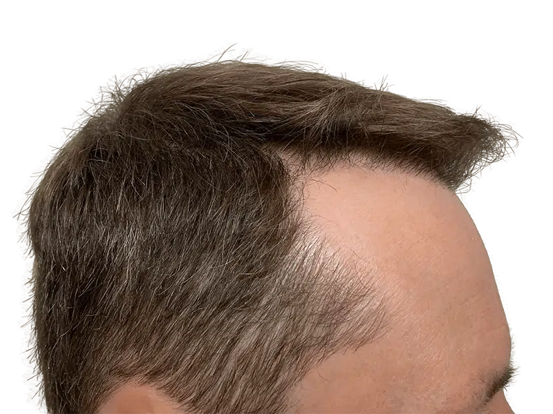 Receding hairline. Before hair transplant. Brown hair with gray. Hair restoration candidate.