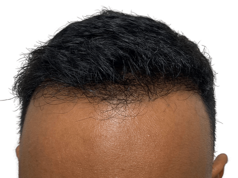 Hair transplant result: Restored hairline with denser, natural-looking hair. Before & after hair restoration procedure.