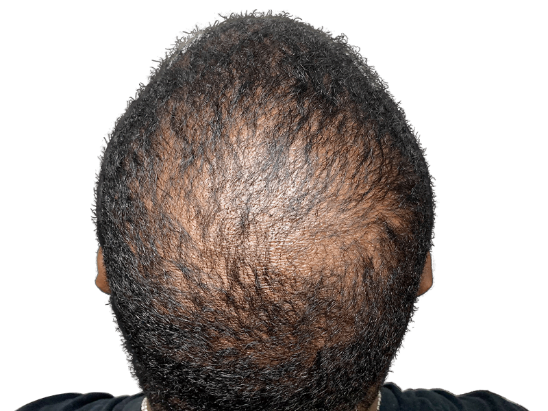 Thinning hair on a Black/Hispanic man's crown. Hair loss example for hair restoration or transplant consideration.