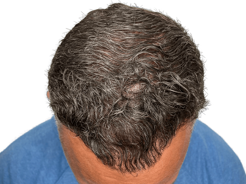 Thinning gray hair, visible scalp. Potential hair restoration candidate. Before/after hair transplant evaluation.