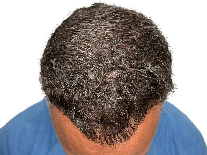 Thinning gray hair, visible scalp. Potential hair restoration candidate. Before/after hair transplant evaluation.