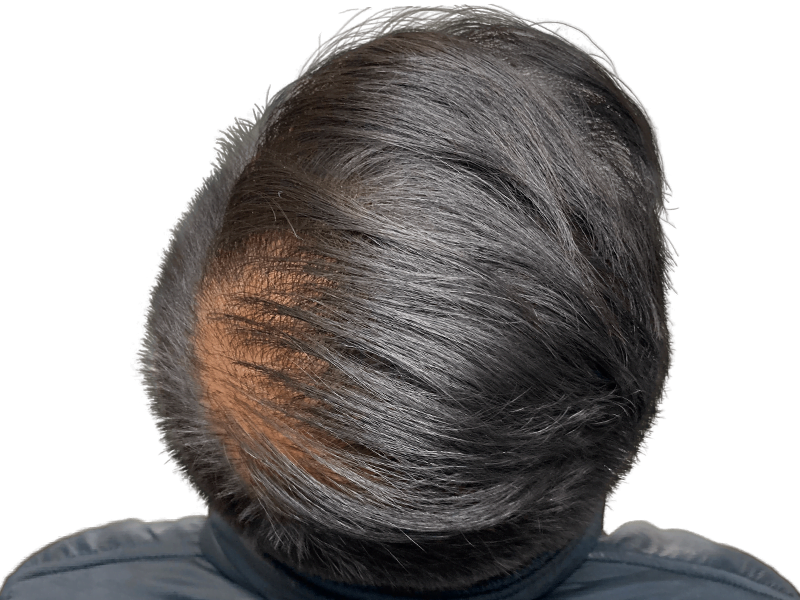 Hair loss before treatment. Thinning dark hair, visible scalp. Consider hair restoration options like transplants.