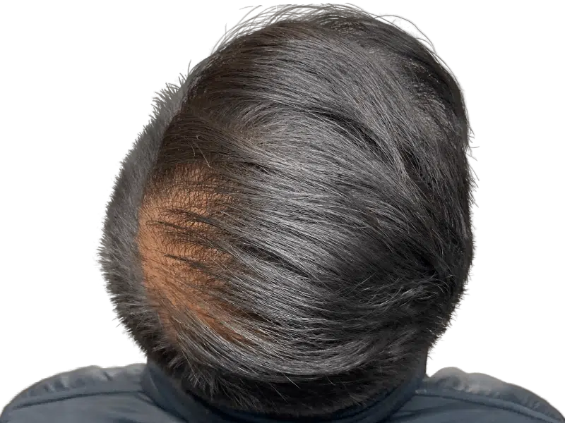 Hair loss before treatment. Thinning dark hair, visible scalp. Consider hair restoration options like transplants.