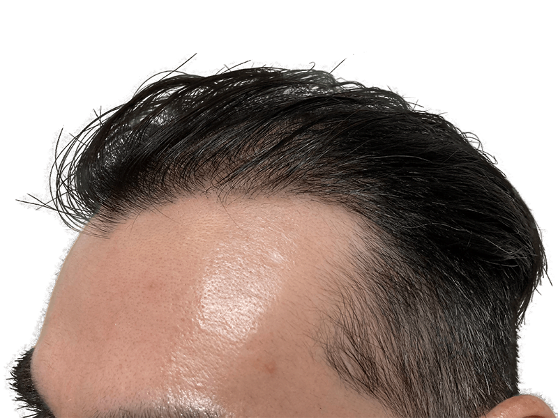 Hair transplant result: Man's forehead showing restored hairline. Hair restoration procedure success.
