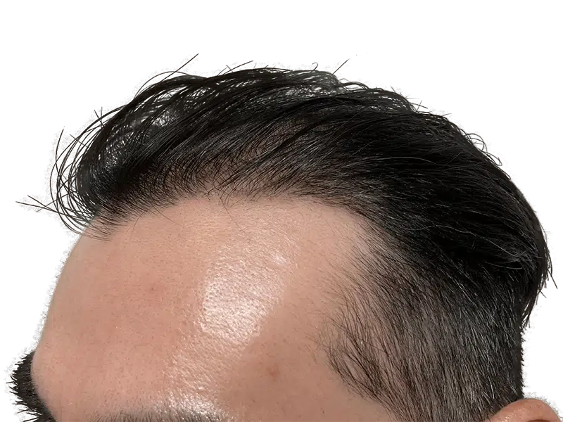 Hair transplant result: Man's forehead showing restored hairline. Hair restoration procedure success.