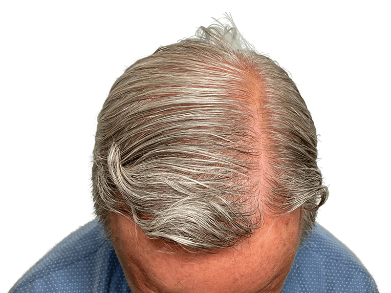 Thinning gray hair at the crown. Consider hair restoration options. Before treatment example. Hair transplant consultation available.
