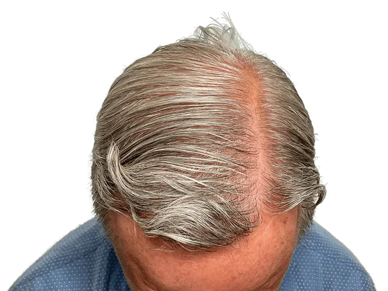 Thinning gray hair at the crown. Consider hair restoration options. Before treatment example. Hair transplant consultation available.